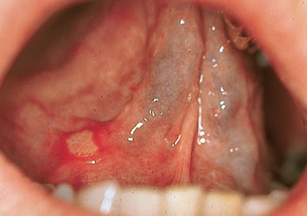 Bakal Menjalani Pembedahan Tonsil